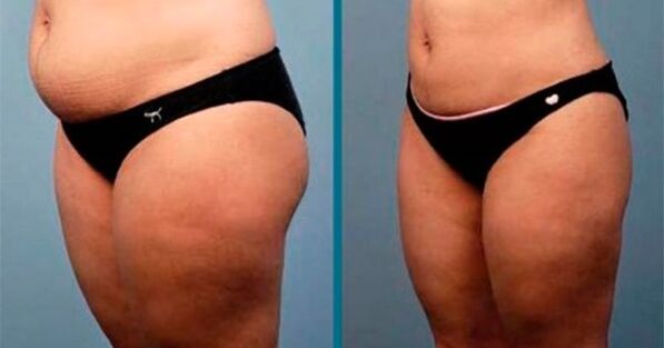Método para perder peso 10 kilogramos en un mes.